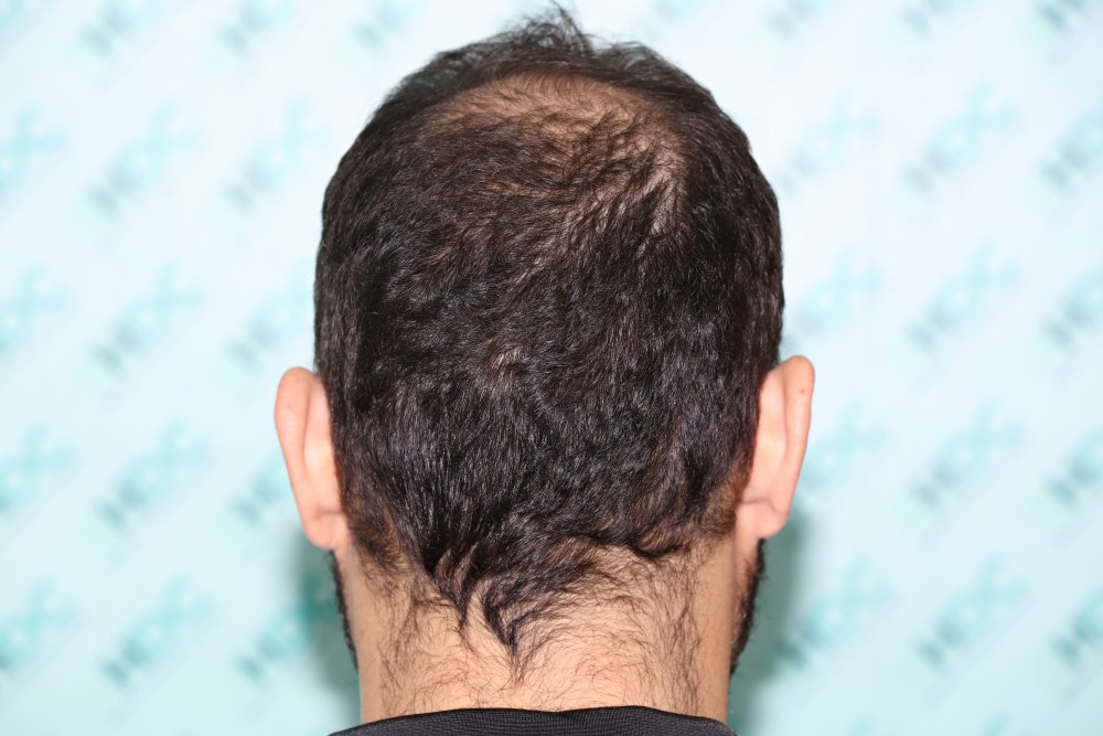 1. Back donor Before Surgery.JPG