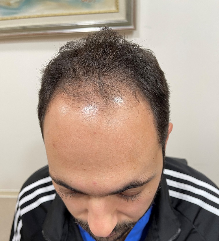 1. Before FUE 2660 grafts.jpg