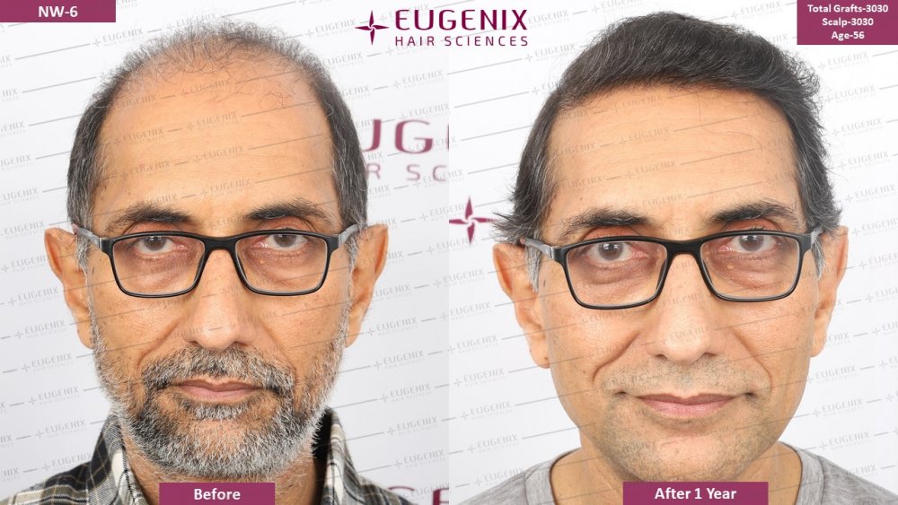 Trust Only the Specialists for Corrective Hair Restoration Procedures | Eugenix  Hair Sciences | Hair loss Forum - Hair Transplant forums