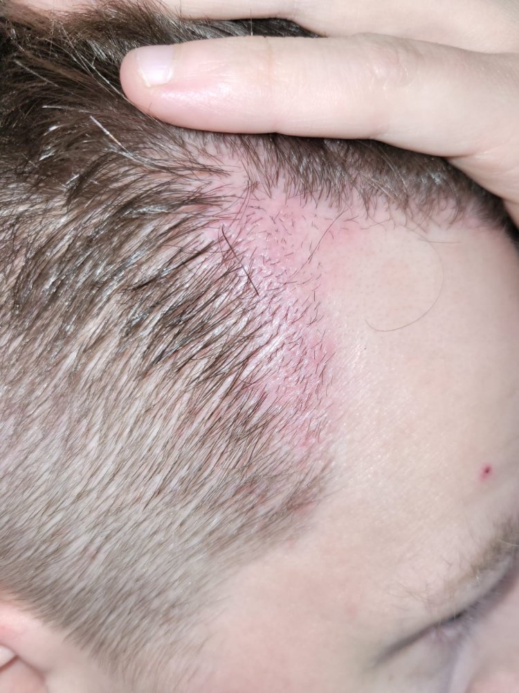 Electrolysis Removal After Bad Hair Transplant Page 3 Hair loss