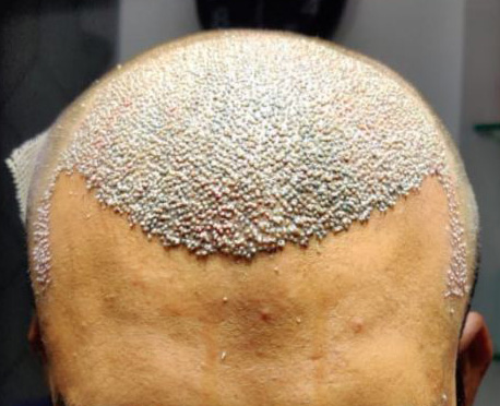 The Perils of Direct Hair Transplant (DHT) | Hair loss Forum - Hair  Transplant forums