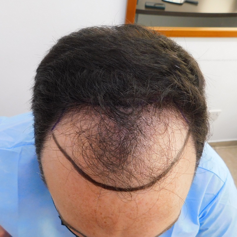 Hair Transplant result – 7 months after – 3200 FUE Grafts - NW class 3 - Dr  Christina HDC | Hair loss Forum - Hair Transplant forums