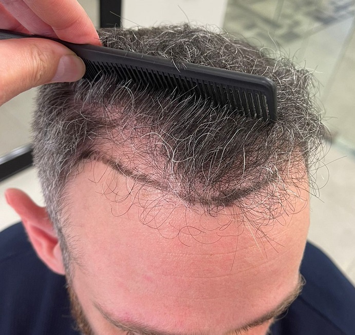 1. Left hairline before.jpg