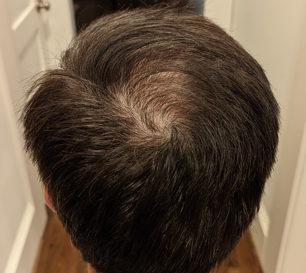 1 year post op - Back.jpg