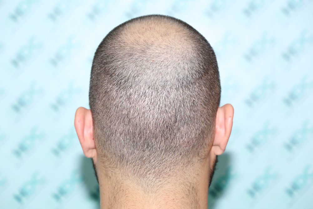 10.1 Back Donor 7 days after.JPG