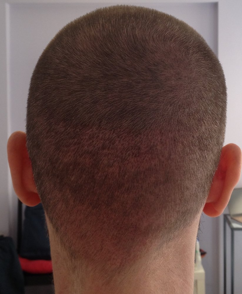 10 days post-op donor (patchy).JPG