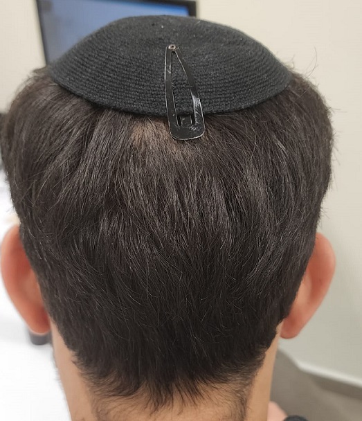 10. Donor After Back View.jpg