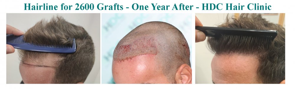 11. Comparison Before, post op and After - Left.jpg