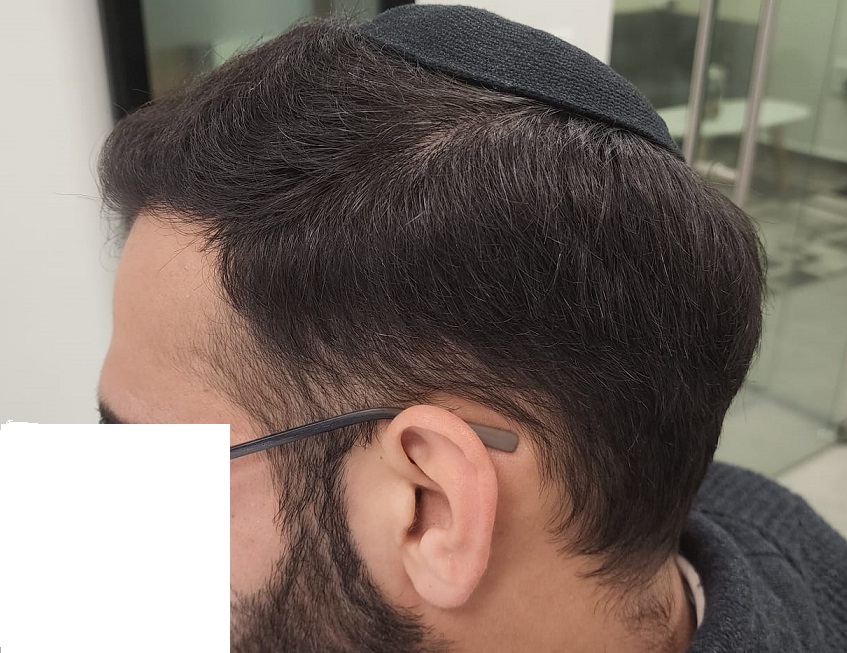 11. Donor after Side View.jpg