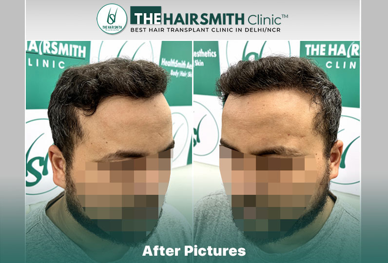 11 months hairsmith hair transplant result - the hairsmith clinic delhi #hairsmithhairtranspla...jpg