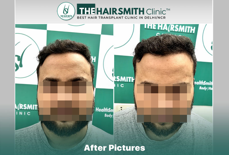 11 months hairsmith hair transplant result - the hairsmith clinic delhi #hairtransplant.jpg