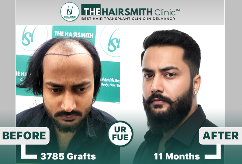 11 months hairsmith hair transplant result - the hairsmith clinic delhi.jpg