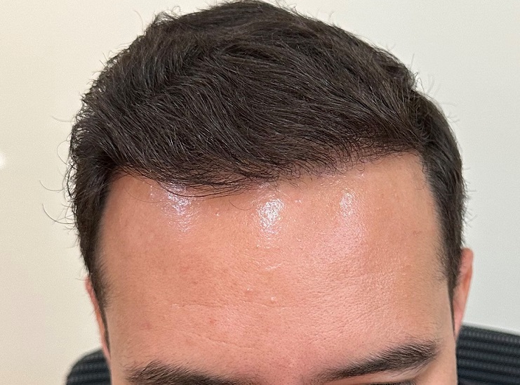 11. Result 8.5 months after Front.jpg