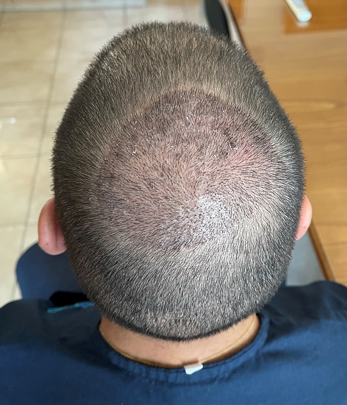 12 days after - Crown.jpg
