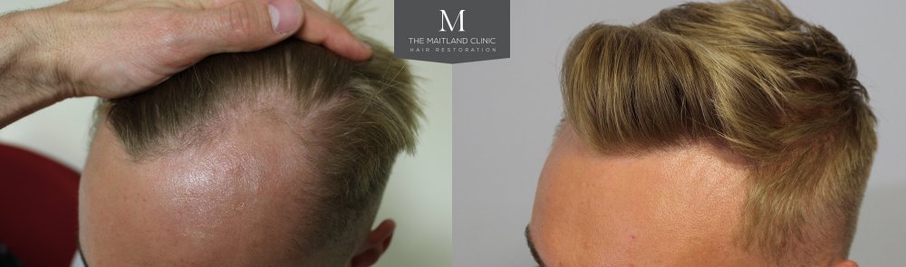 122, Before and After, The Maitland Clinic, Dr Ball, Left 45.jpg