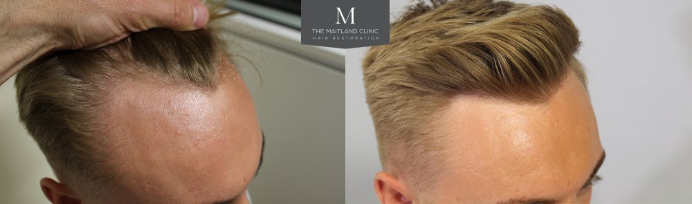 122, Before and After, The Maitland Clinic, Dr Ball, Right 45.jpg