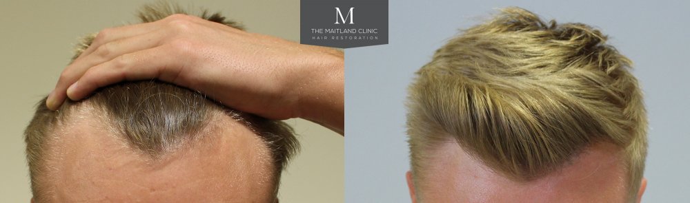 122 Double Front Tilt.jpg