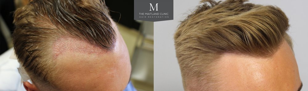 122. Immediate Post-Op + 2 Years Post Op.jpg