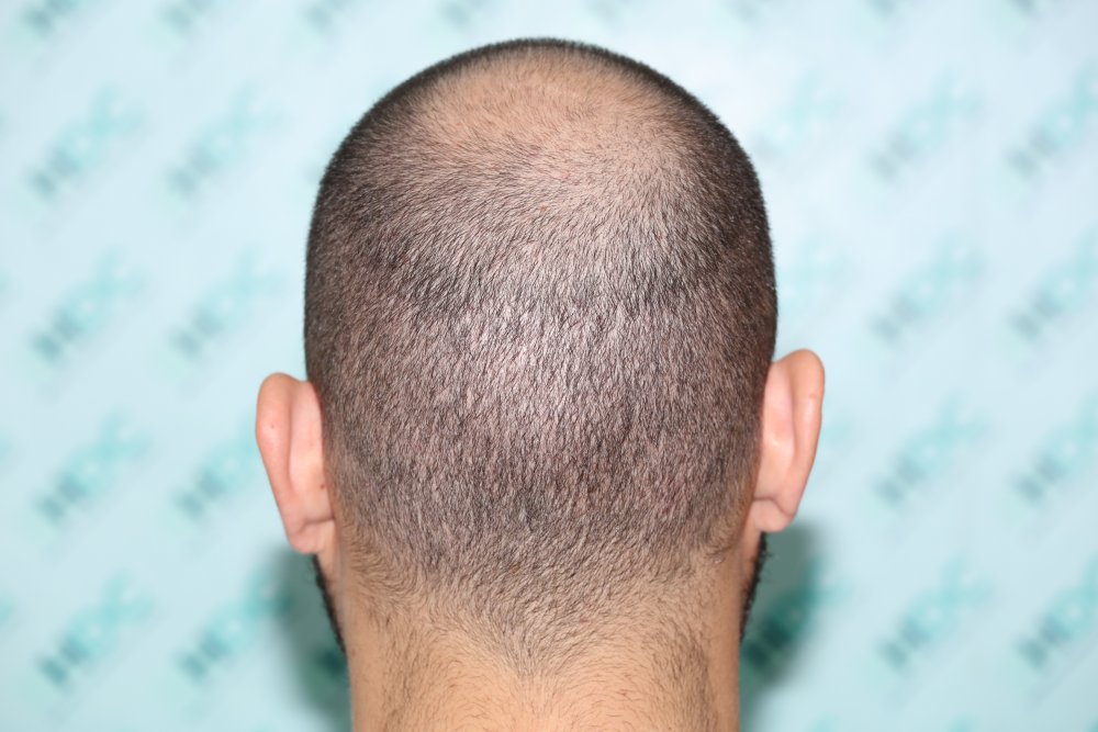 13.1 Back donor 10 days after.JPG