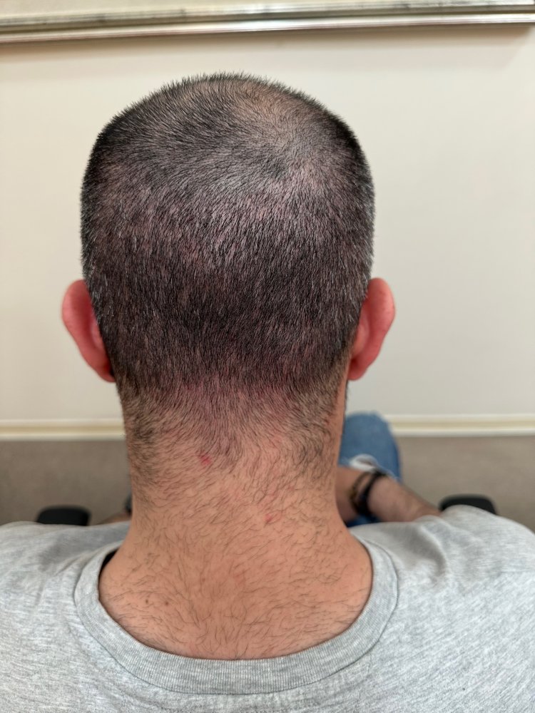 13 days after - Donor back.jpg