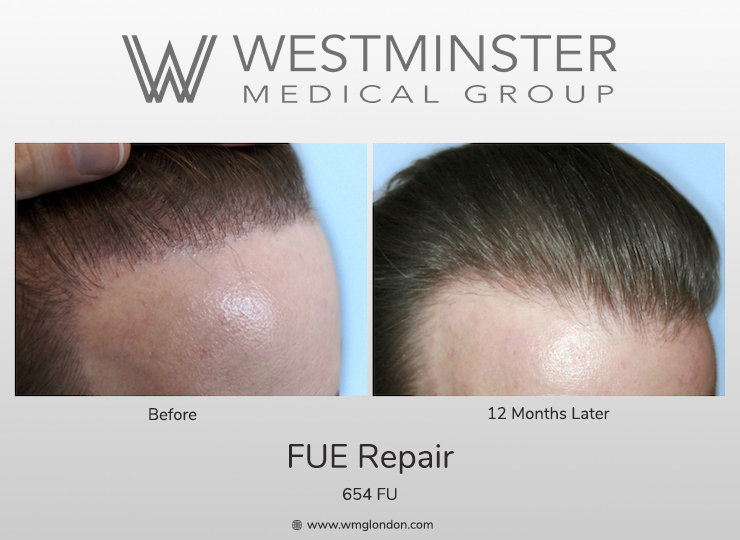 Westminster Medical Group Hairline Softening Procedure 654 Single