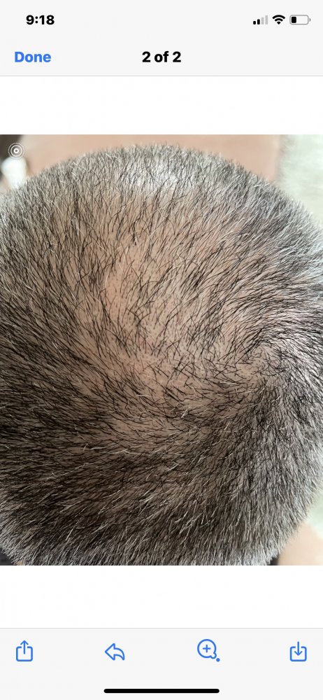 Oral minoxidil at 6 months | Hair loss Forum - Hair Transplant forums