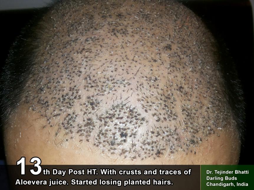 My Hairtransplant story with Dr. Tejinder Bhatti | Hair loss Forum - Hair  Transplant forums