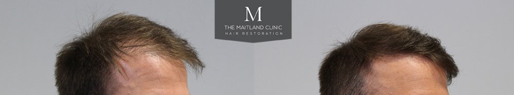 1660 Grafts FUE, 12 month, Before and After. 2.jpg