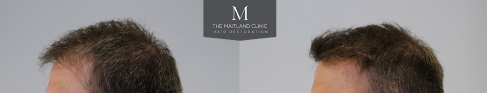 1660 Grafts FUE, 12 month, Before and After. 3.jpg