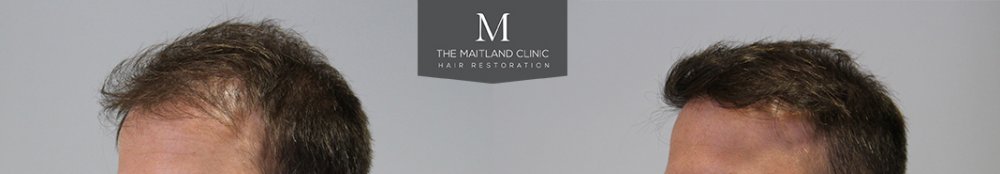 1660 Grafts FUE, 12 month, Before and After. 4.jpg