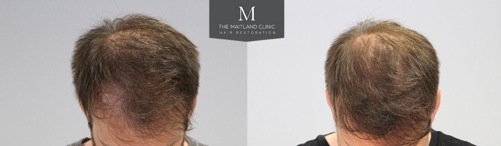 1660 Grafts FUE, 12 month, Before and After.5.jpg