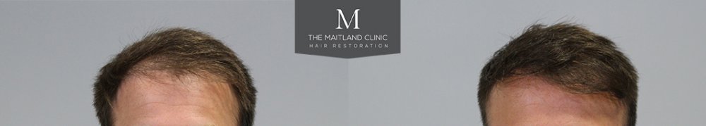 1660 Grafts FUE, 12 month, Before and After.6.jpg