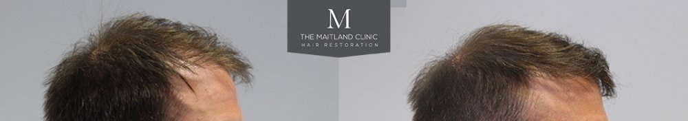 1660 Grafts FUE, 12 month, Before and After.7.jpg