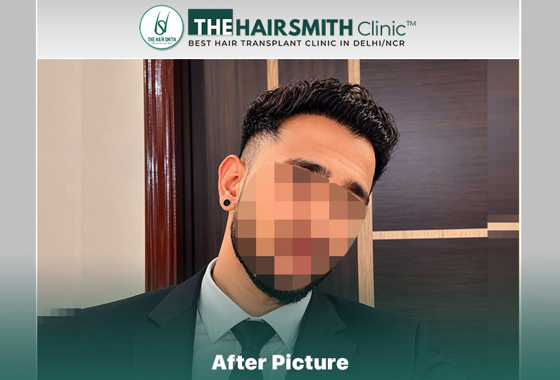 18 months hairsmith hair transplant result - the hairsmith clinic delhi #hairtransplant.JPG