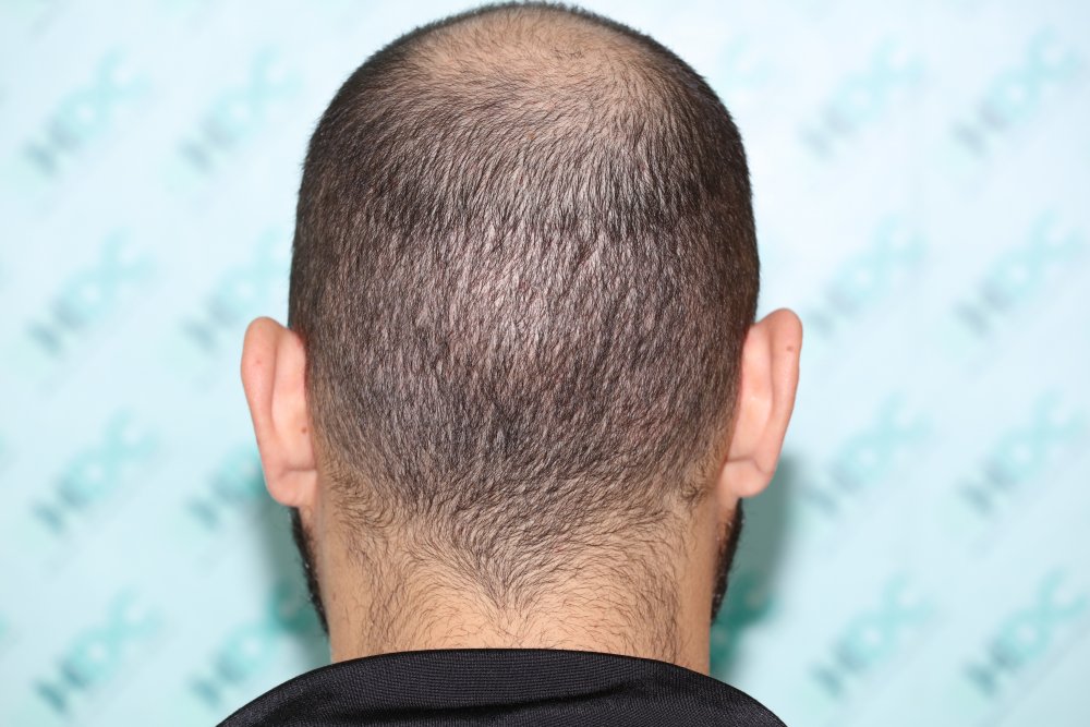 19.1 Back donor 16 days after.JPG