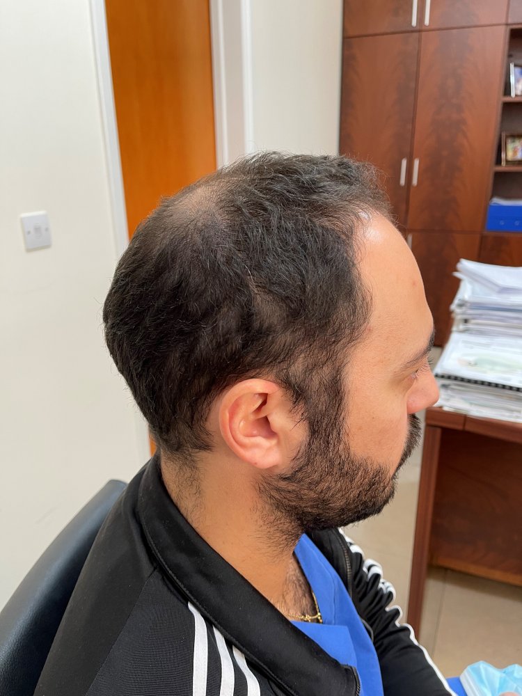 1a. Back donor Before Surgery.jpg