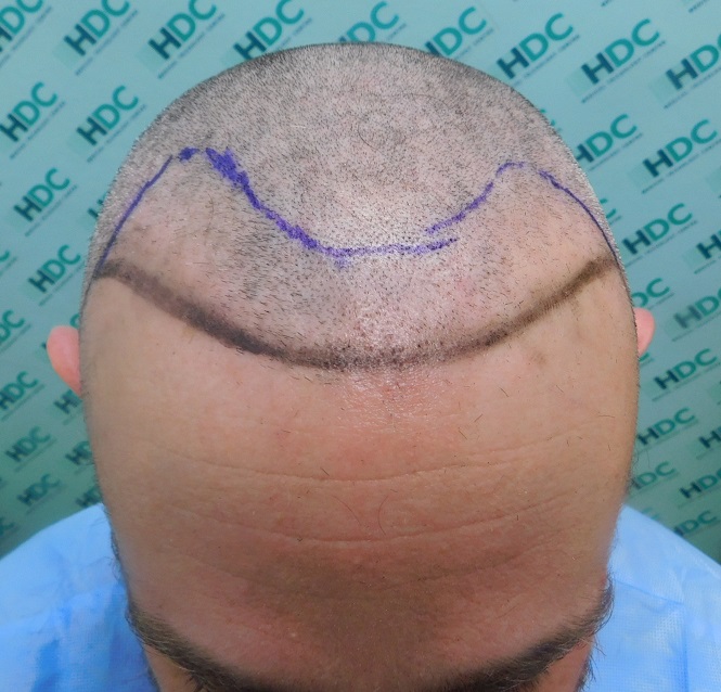 1a Hairline design.JPG