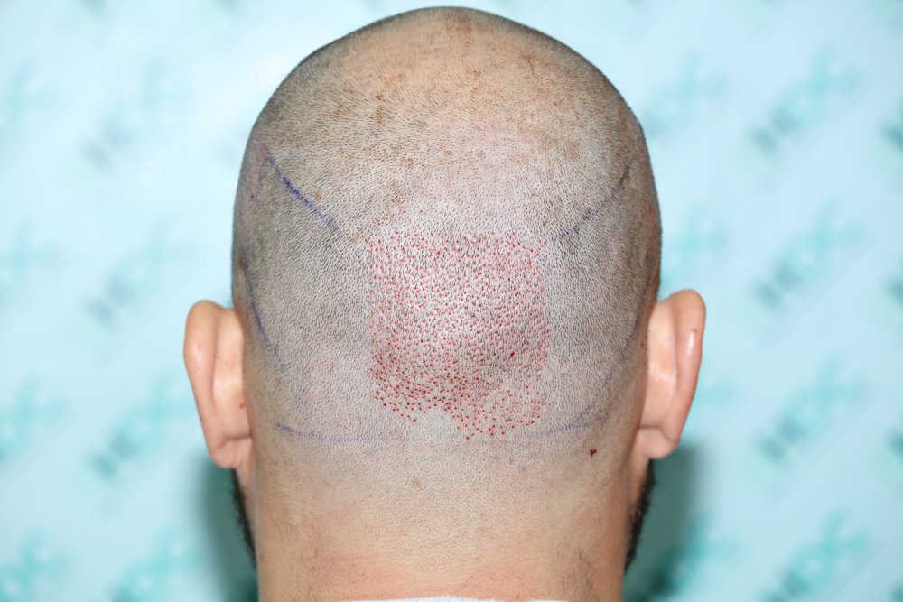 2. Back donor 1st day of surgery.JPG