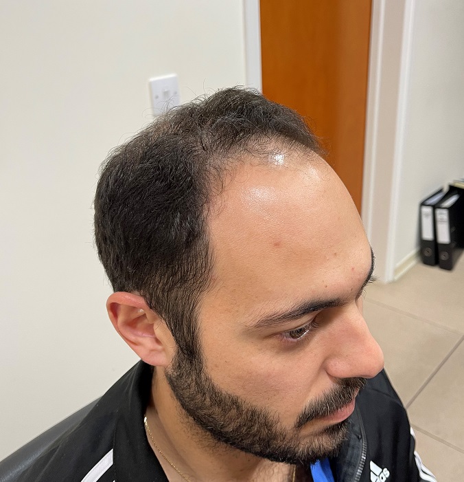 2. Before FUE1 - left.jpg