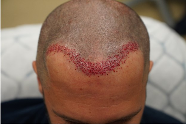 2. Hairline right after 1st surgery.jpg