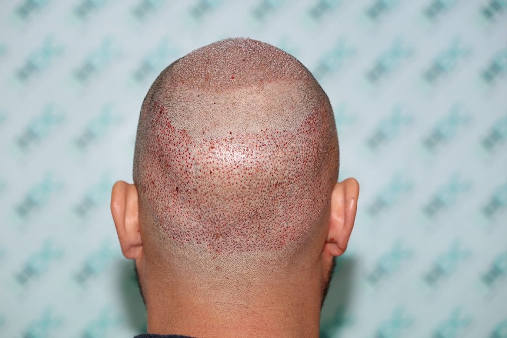 2. Post op - Donor - FUE2.JPG
