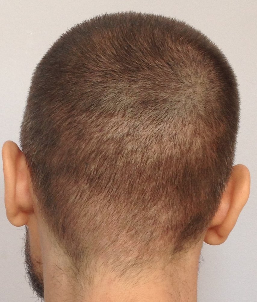 20 days post-op donor (bald spot obvious).JPG