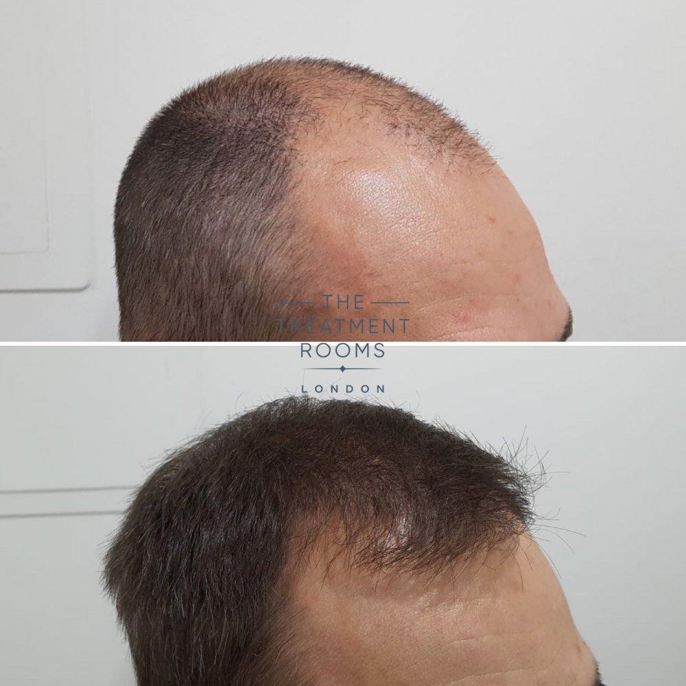 2000 graft hair transplant before and after.jpg