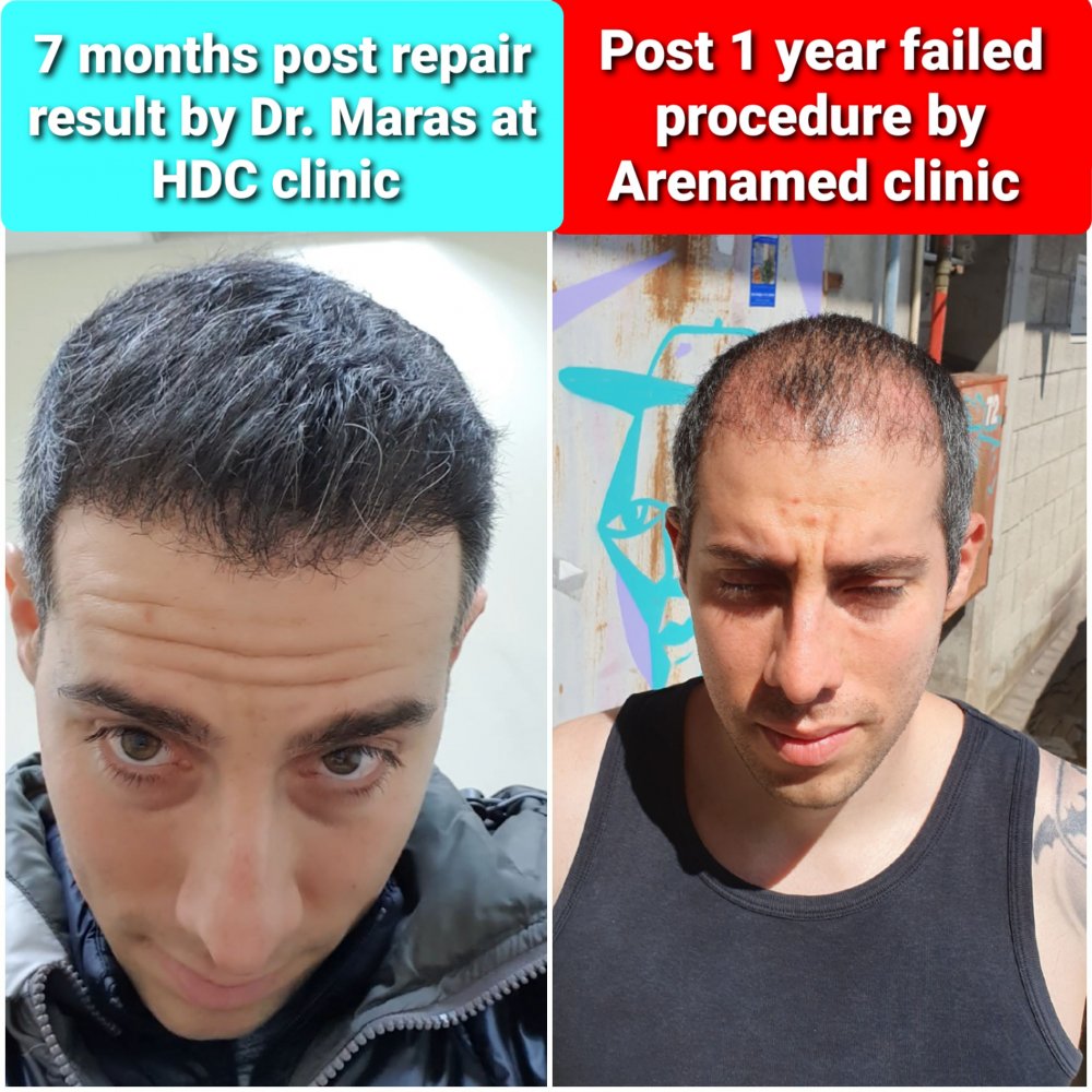 Coordinator of HDC clinic in Cyprus, accepting from all around the globe |  Hair loss Forum - Hair Transplant forums