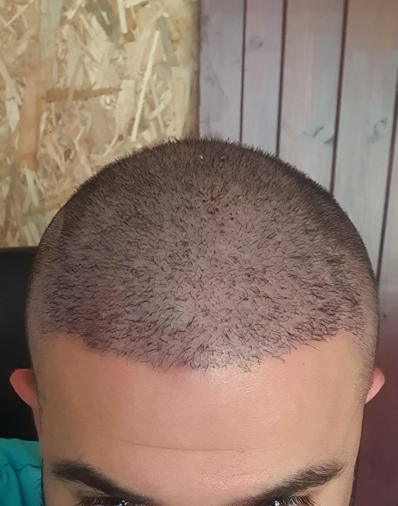Day 8 - Hair falling off with the scabs | Hair loss Forum - Hair Transplant  forums