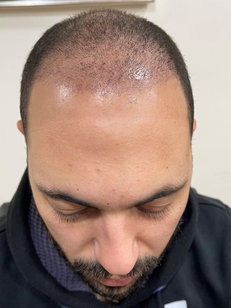 27. 2 Months After.jpg
