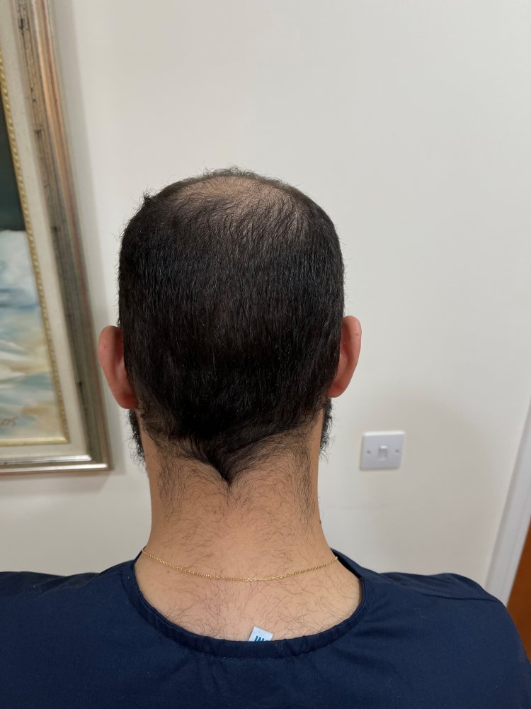 27.  Back Donor 52 days after.jpg
