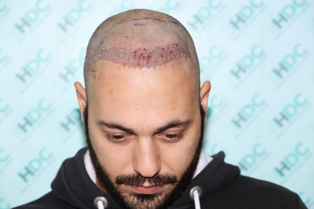 3. 1st day of surgery for 1534 grafts.JPG