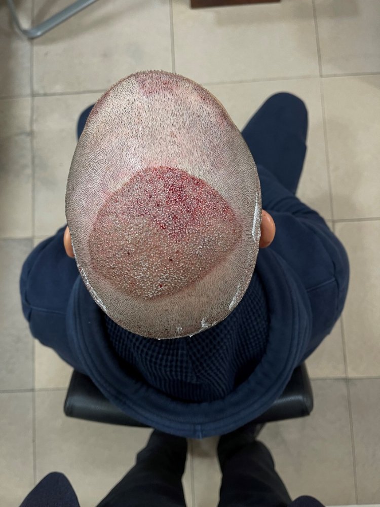 3. 2700 Grafts.jpg