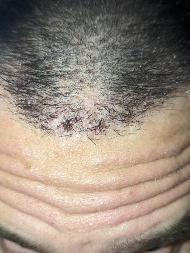 3. Hairline 2weeks after 1st surgery.jpg